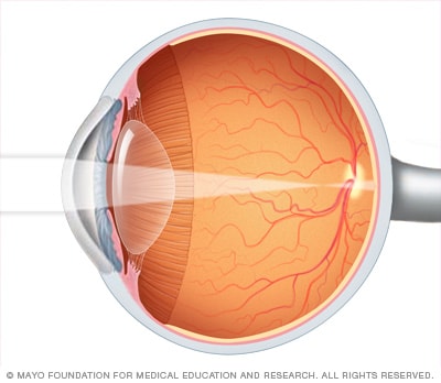 Image showing nearsightedness (myopia)