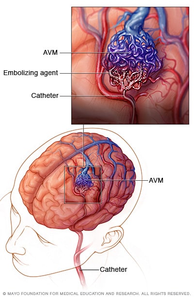 Embolización endovascular