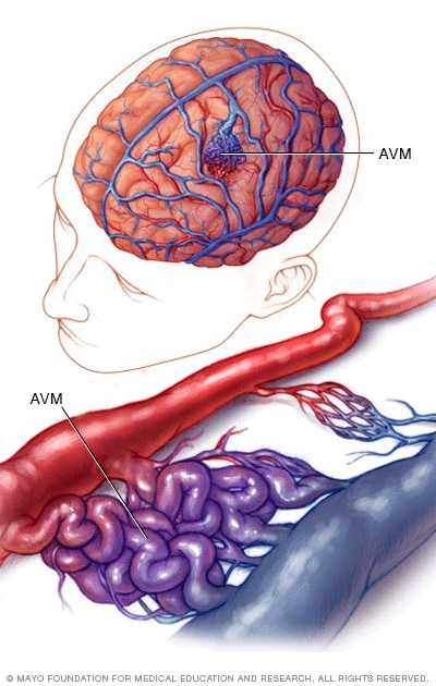 Malformacion Arteriovenosa Cerebral Sintomas Y Causas Mayo Clinic