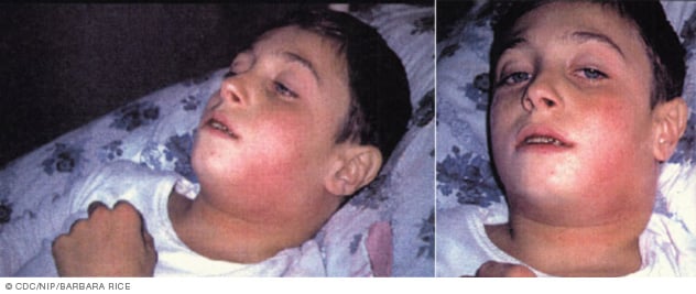 Diphtheria
