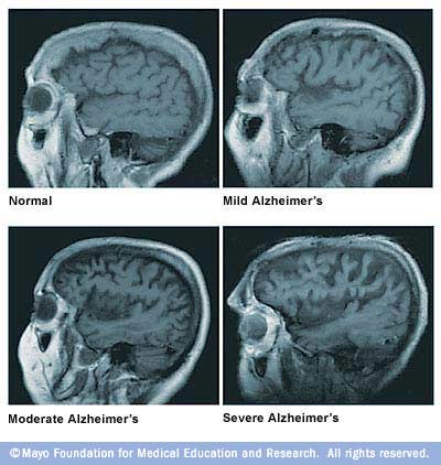 Brain atrophy and Alzheimer's