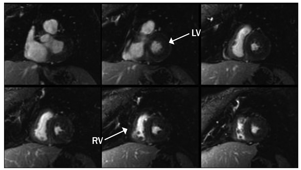 Imágenes de la secuencia de mejora retrasada del miocardio