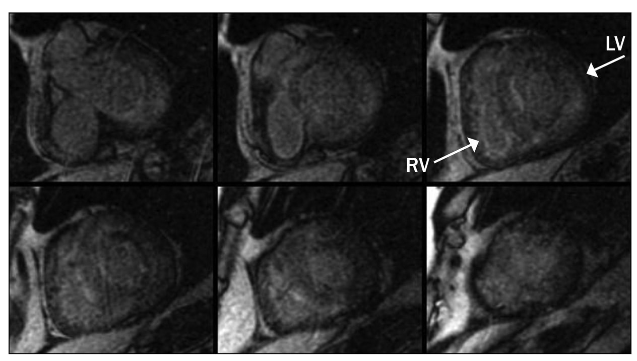 Images of myocardial delayed enhancement sequence in a patient with cardiac amyloidosis