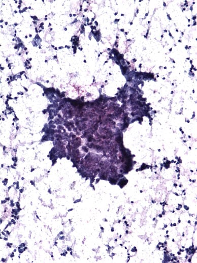 Image of thyroid cytology of a specimen of papillary thyroid carcinoma