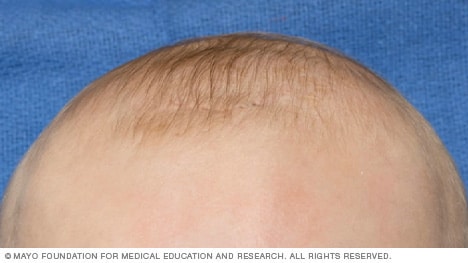 Partes blandas de la cabeza de un recién nacido (fontanelas)