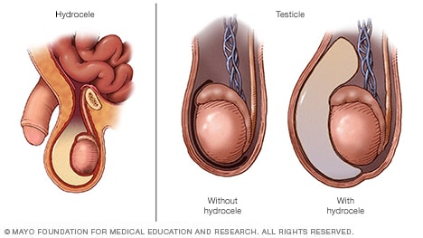 Hydrocele