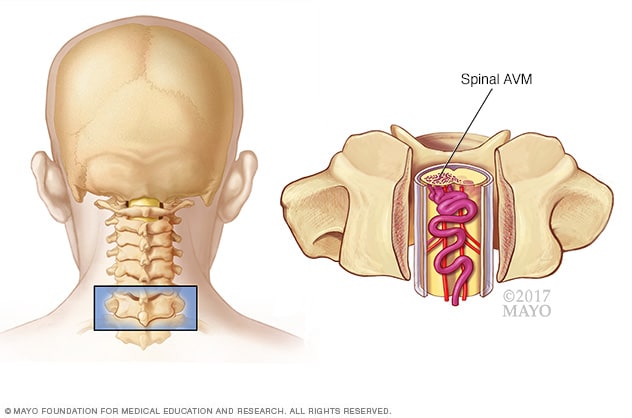 Malformación arteriovenosa espinal