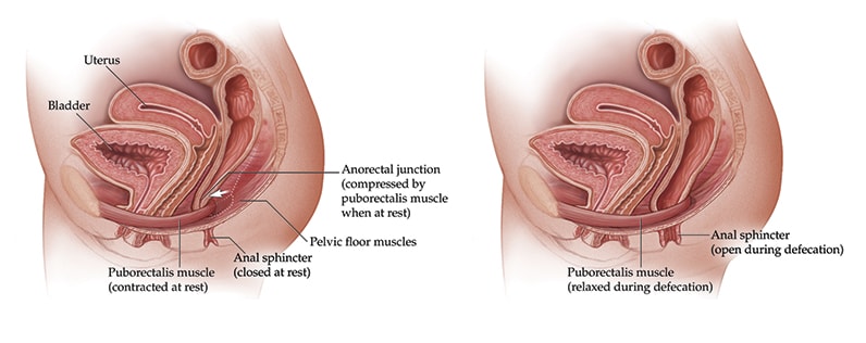 Illustration of puborectalis muscle at rest and during defecation