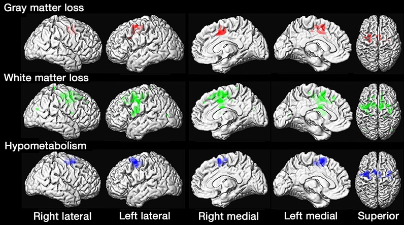 Images of brains of patients with PPAOS compared with controls