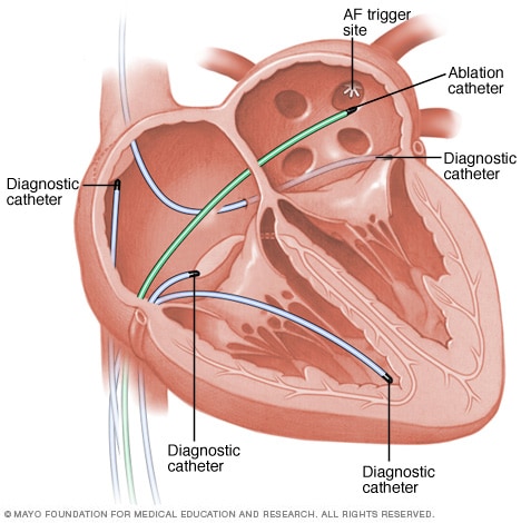 Un corazón durante la ablación por catéter