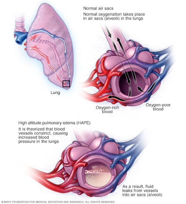 High-altitude pulmonary edema