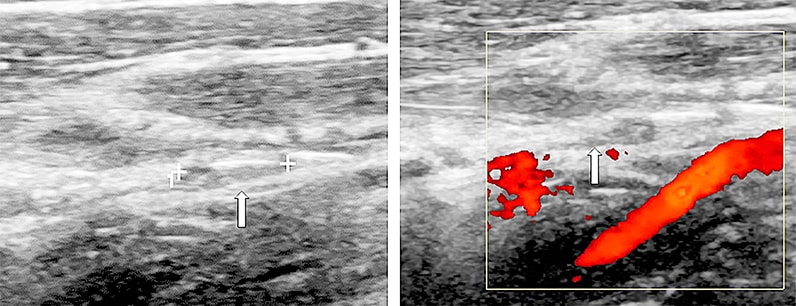 Neck ultrasound of patient with recurrent metastatic papillary thyroid cancer 10 months after ultrasound-guided percutaneous ethanol ablation