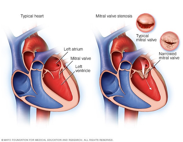 Left ventricular hypertrophy - Symptoms and causes - Mayo Clinic