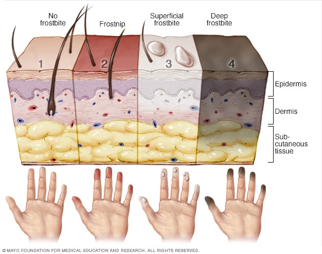 frostbite symptoms