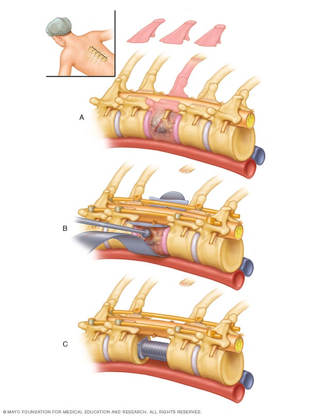 Extirpación quirúrgica de un tumor metastásico vertebral y estabilización.