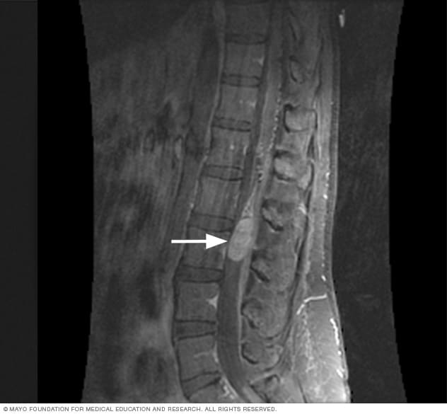 MRI scan of spinal cord tumor