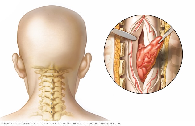 Cirugía de cuello con tumor espinal