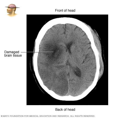 Tejido cerebral dañado por accidente cerebrovascular