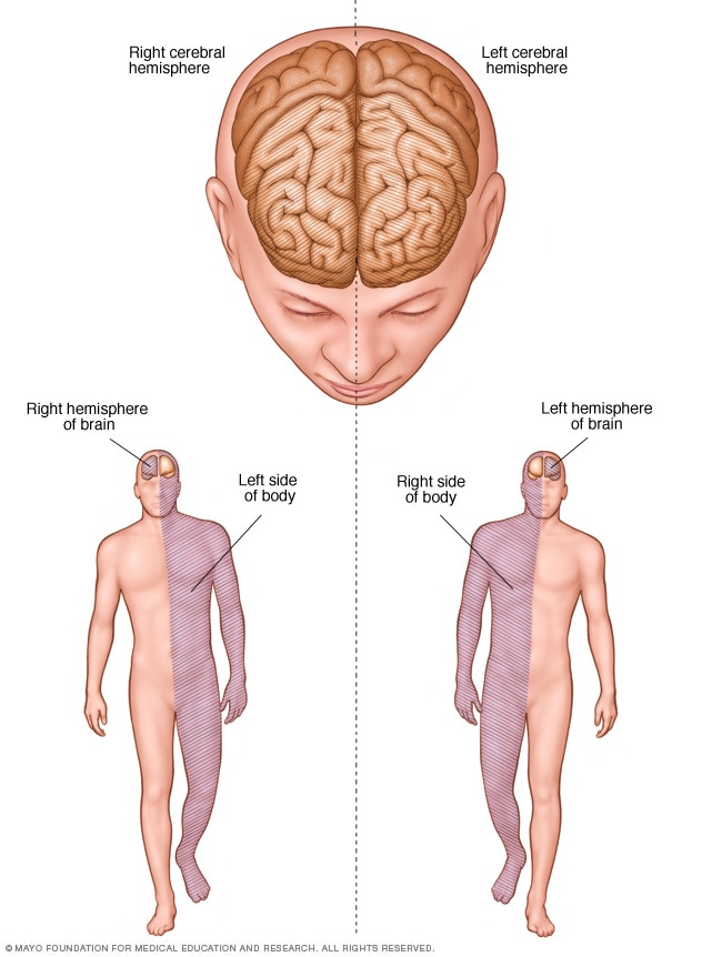 Stroke - Diagnosis and treatment - Mayo Clinic