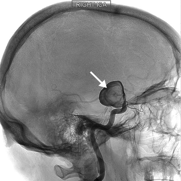 Cerebral angiogram