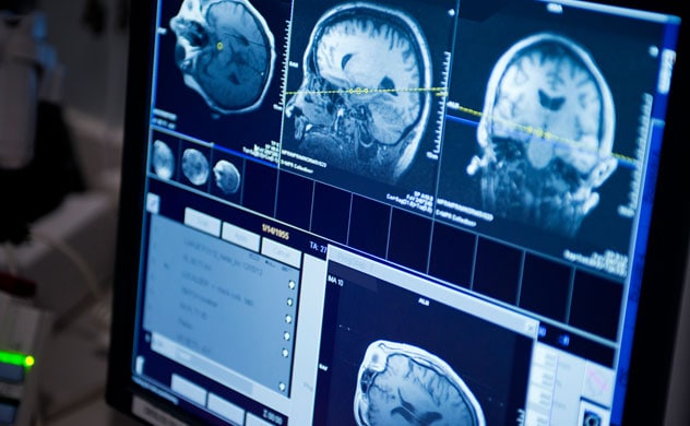 IRM de tumor cerebral