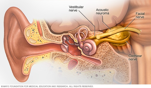 Tumor Cerebral Sintomas Y Causas Mayo Clinic