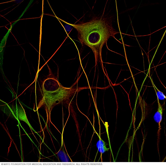 Células de glioma malignas