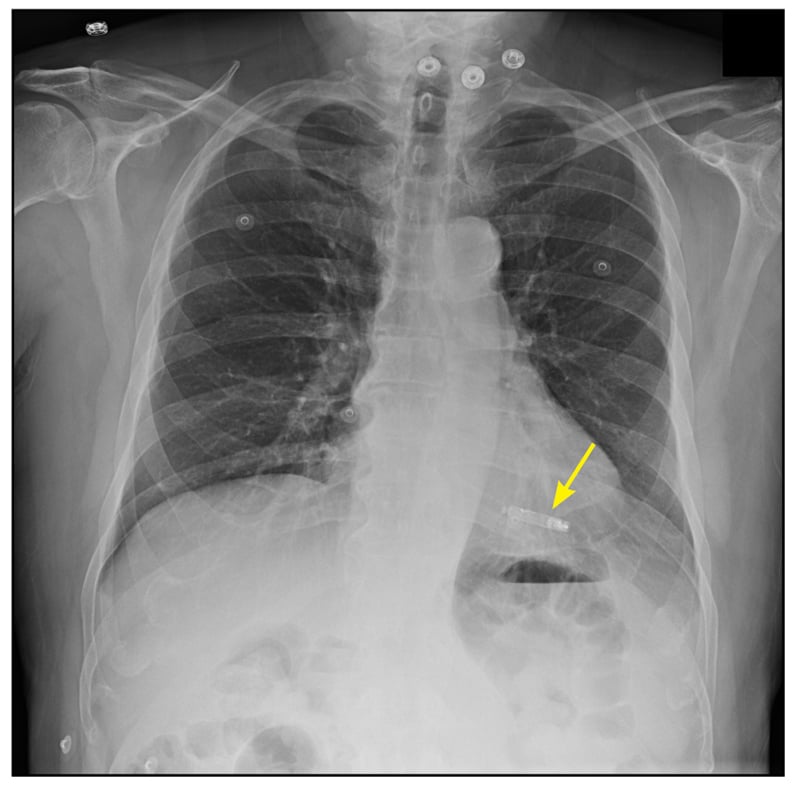 Implanted leadless pacemaker