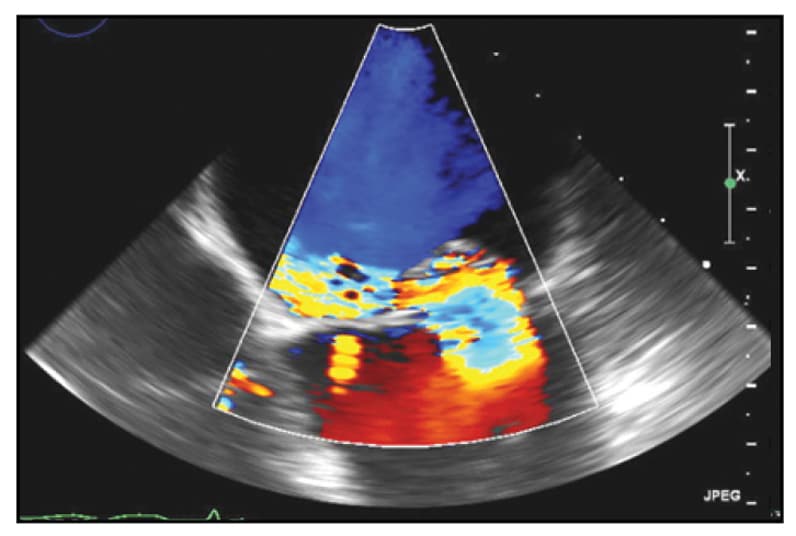 Image of TEE view of severe mitral valve regurgitation