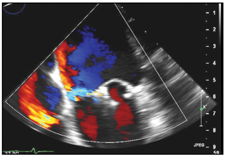 Image of mild residual MR