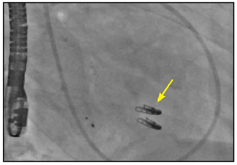 Image of two MitraClip devices