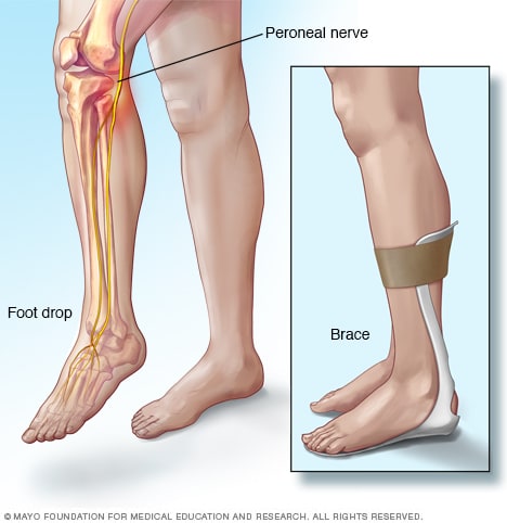 Illustration of foot drop and brace
