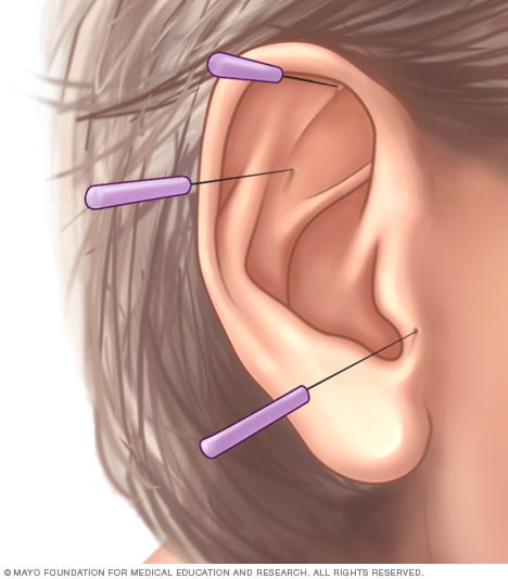 耳针疗法