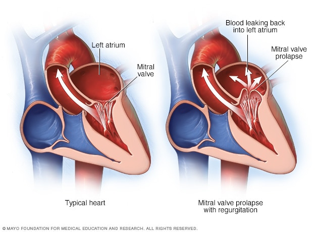 Corazón con prolapso y regurgitación de la válvula mitral