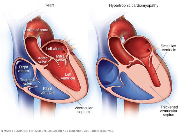 قلب طبيعي وقلب مصاب باعتلال العضلة القلبية الضخامي