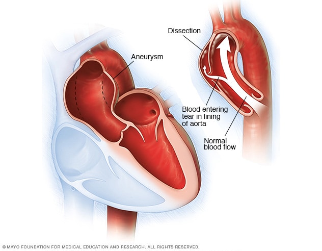Thoracic Aortic Aneurysm Symptoms And Causes Mayo Clinic thoracic-aortic-aneurysm-symptoms-and-causes-mayo-clinic