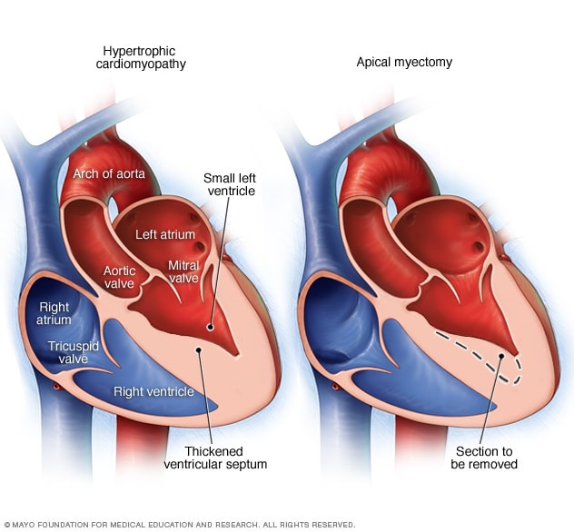 hypertrophy of the heart