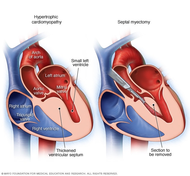 Septal myectomy Mayo Clinic