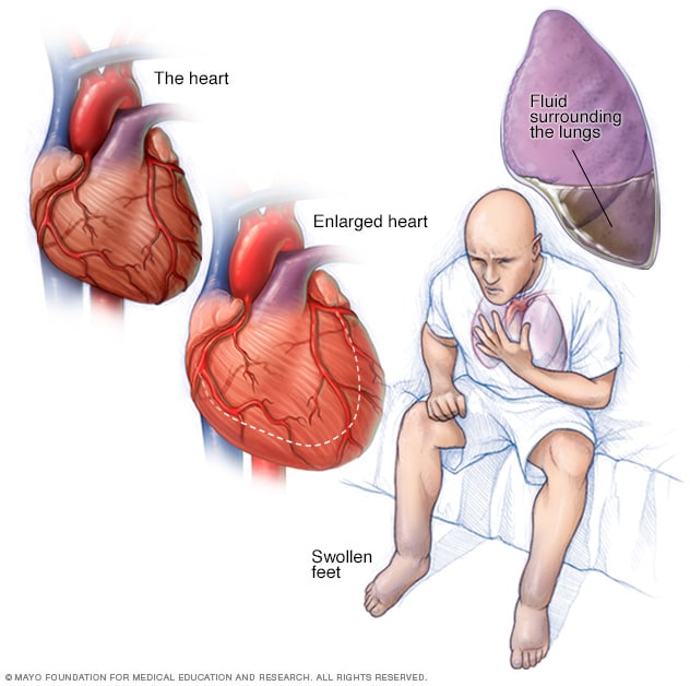 Ilustración de una persona con insuficiencia cardíaca