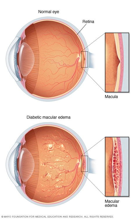 retinal edema