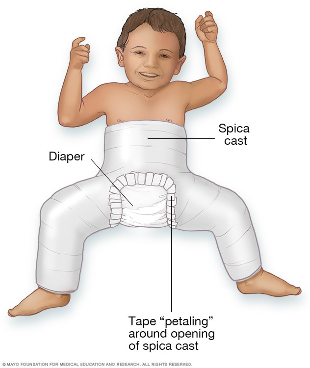 Infant in a spica cast.