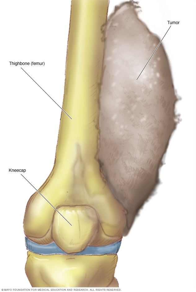 Illustration showing Ewing's sarcoma<br /><br /><br /><br />
