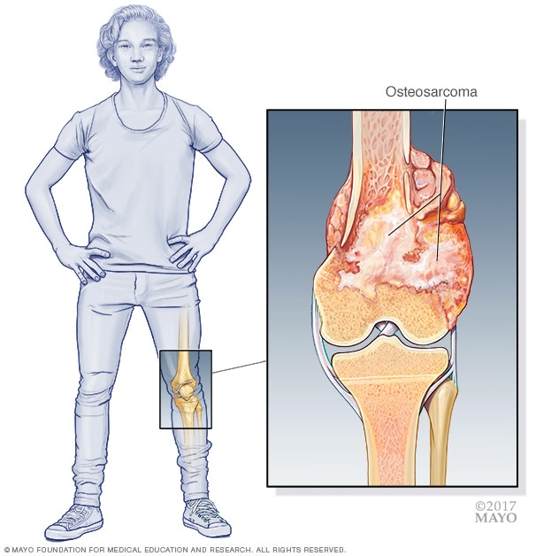 Illustration showing osteosarcoma<br /><br /><br /><br />
