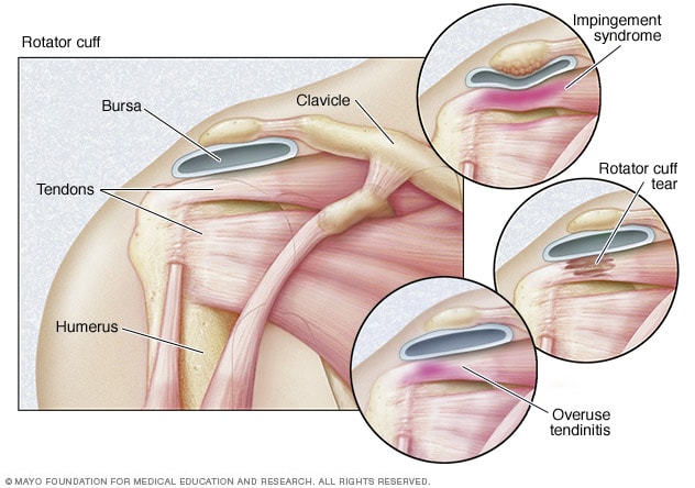 Illustration of three types of rotator cuff injuries.