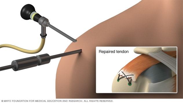 Ilustración de reparación artroscópica de tendón