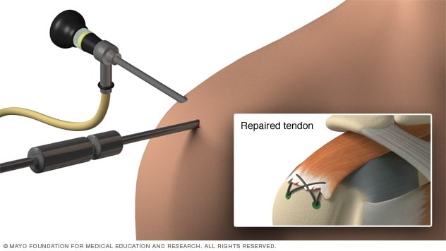 Rotator cuff injury - Diagnosis and treatment - Mayo Clinic