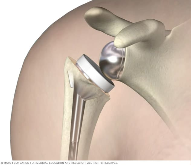 Illustration of a reverse shoulder replacement