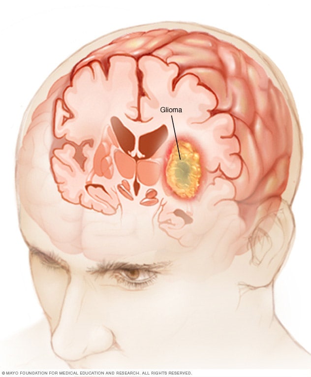 Brain Tumor Size Chart Mm