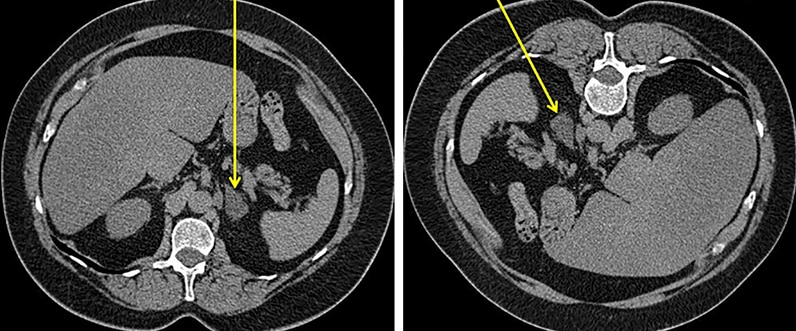 Image from CT scan from patient with a left adrenal mass