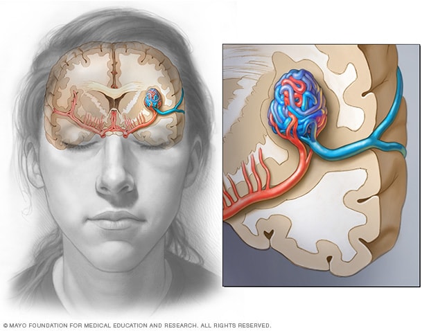 Malformación arteriovenosa cerebral